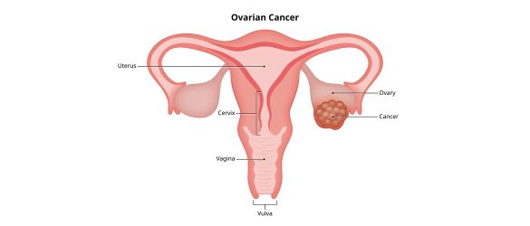 Ovarian Cancer