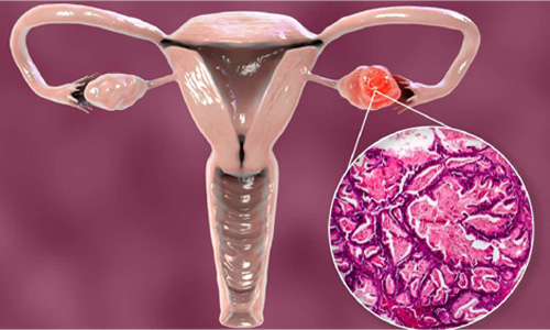 What is Ovarian Cancer