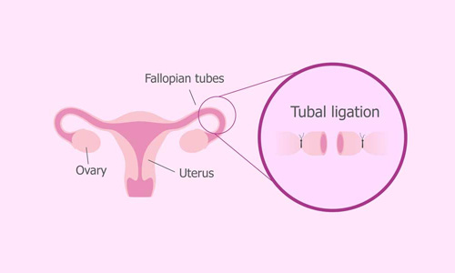 Tubal ligation