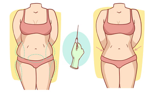 Benefits-of-Liposuction