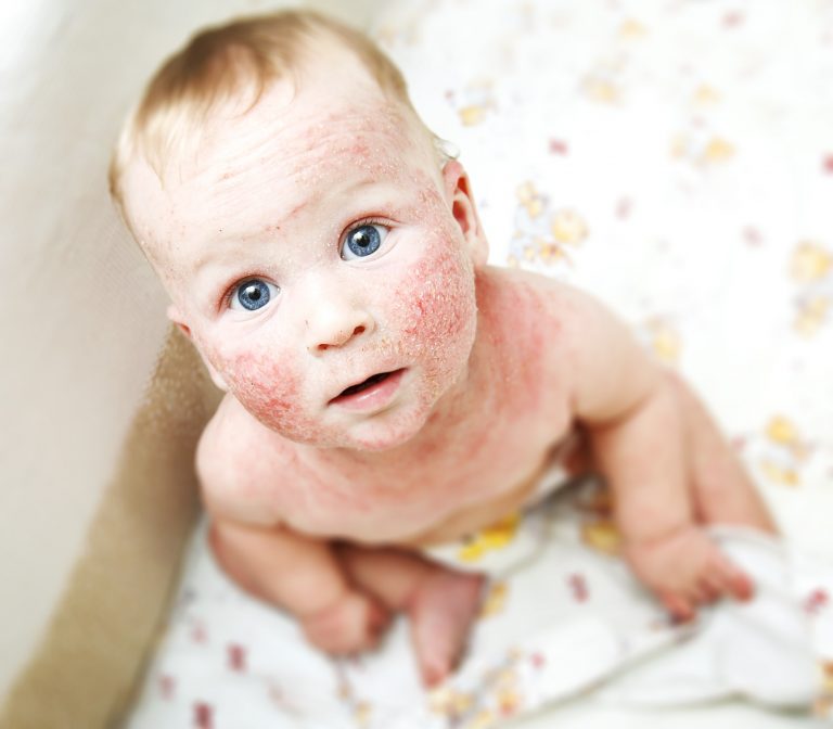 Every Parent must-know the Skin issues Baby might face!