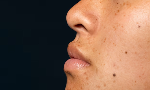 Reduction-of-Hyperpigmentation