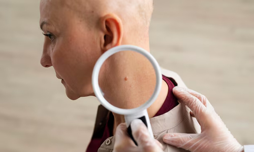 Skin-Cancer-Prevention