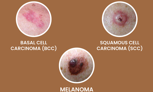 Types of Skin Cancer