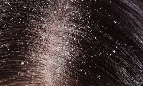 How-to-Get-Rid-of-Dandruff