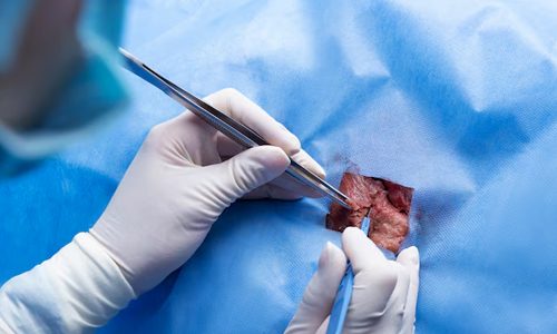 Biopsy Procedures