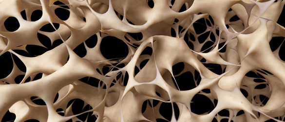 Osteoporosis Uncovered