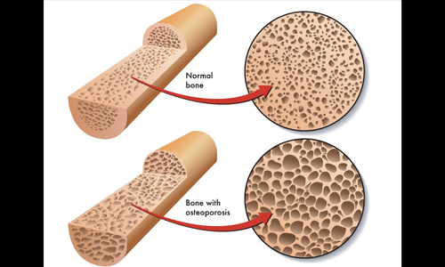 What is Osteoporosis