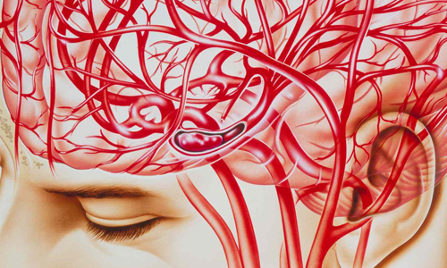 What-Happens-in-the-Body-During-a-Migraine