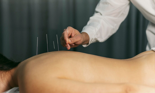 Acupuncture