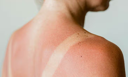 Causes of sunburn